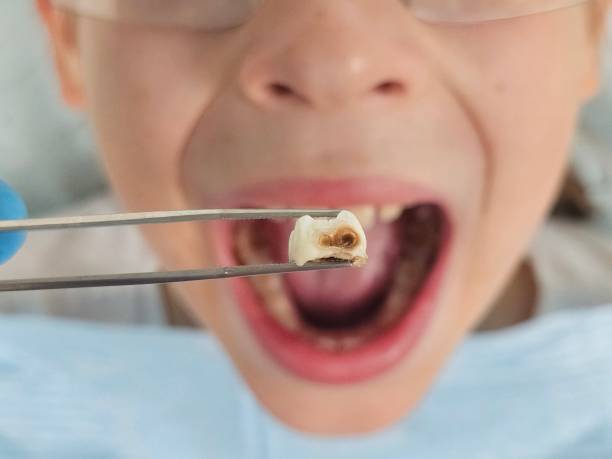 Best Broken or Chipped Tooth Repair in Maple Plain, MN